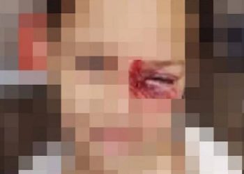 Criança é ferida pelo padrasto com cabo de vassoura em Pouso Alegre