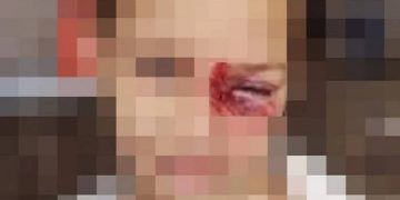 Criança é ferida pelo padrasto com cabo de vassoura em Pouso Alegre