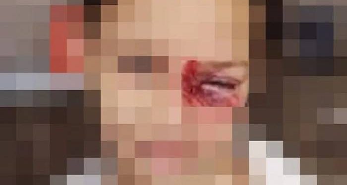 Criança é ferida pelo padrasto com cabo de vassoura em Pouso Alegre