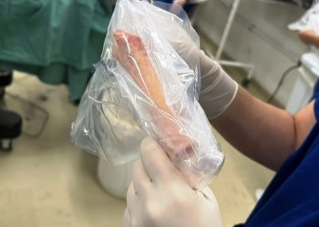 Hospital Samuel Libânio realiza procedimento inédito de aloenxerto (veja vídeo)