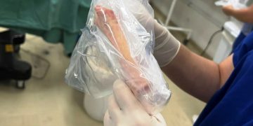 Hospital Samuel Libânio realiza procedimento inédito de aloenxerto (veja vídeo)